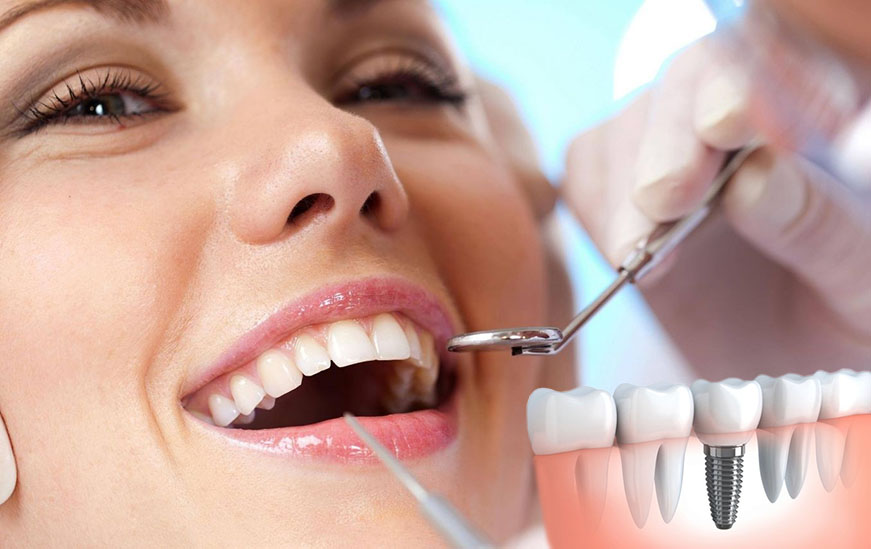 Todo lo que debes saber acerca de los implantes dentales